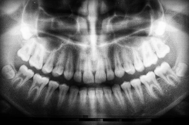 Dental Radiograph X-Ray