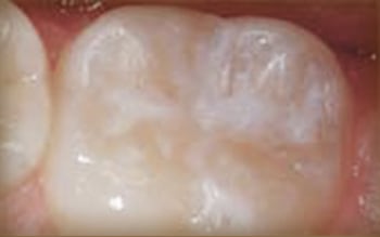 Tooth Cavity After Sealant Applied